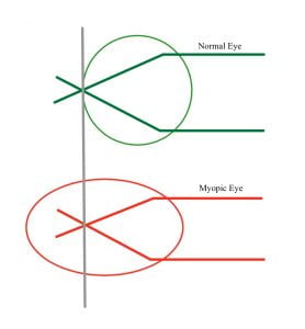 myopia line diagram