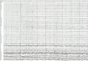 Raw EEG data consisting of many horizontal lines waving up and down.