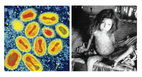 The left image shows a group of magnified viruses. The right image is a photograph of a child, who is very thin. 