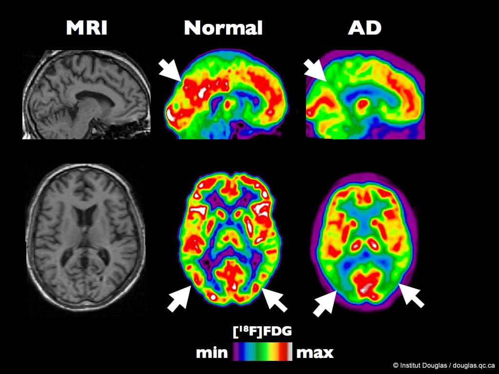 Image comparing the differences between a MRI brain scan and a PET brain scan. Image also shows the differences in PET scan colors between a “healthy” brain, and a brain from a patient with Alzheimer’s Disease. 